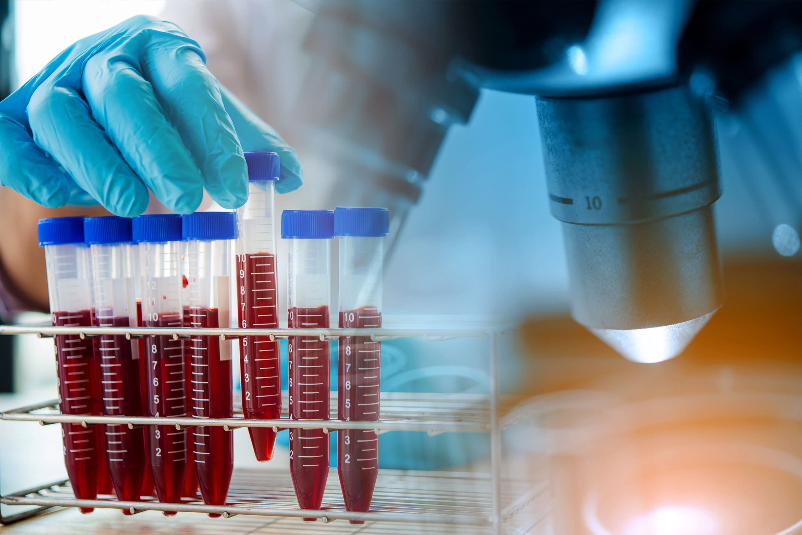 Chronic Lymphocytic Leukaemia